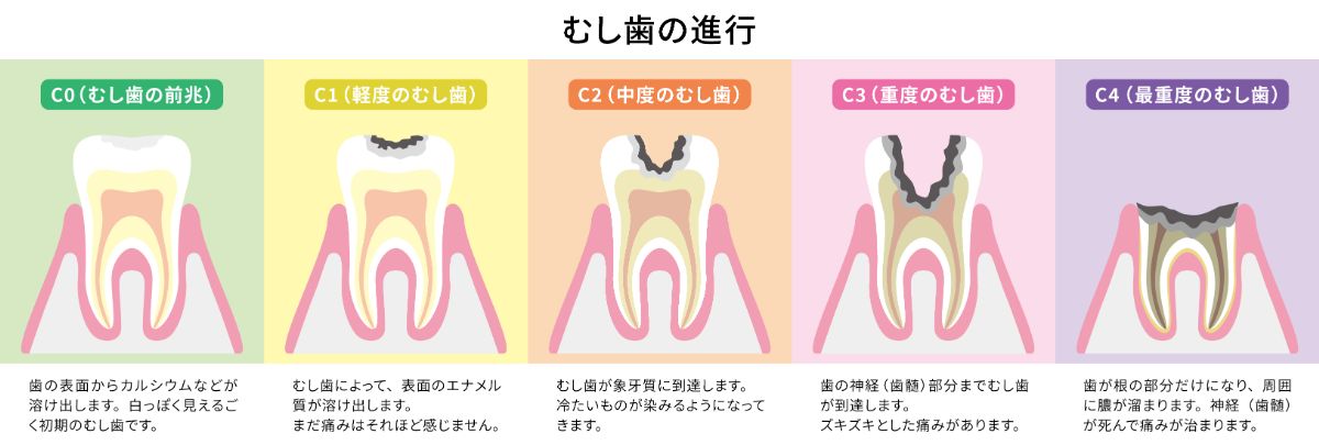 虫歯の進行と治療法の一例